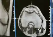新启动的量子增强MRI项目旨在提升早期癌症检测能力